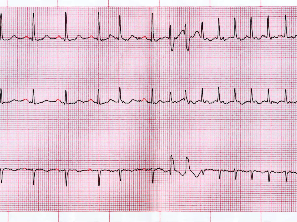 Migotanie przedsionków a ryzyko udaru mózgu – dlaczego ta arytmia jest tak groźna?