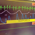 Kołatanie serca – kiedy to normalne, a kiedy nie?
